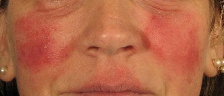 Горит лицо и болит голова причины недуга